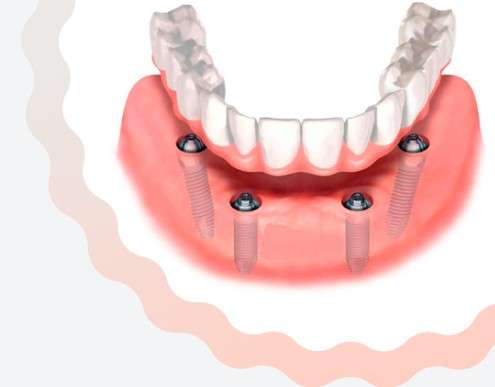 Имплантация зубов по концепции All-on-4: Инновационный подход