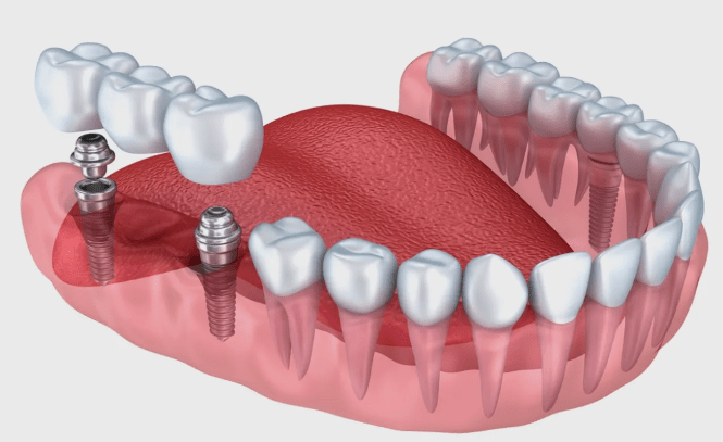 Методы и виды имплантации зубов