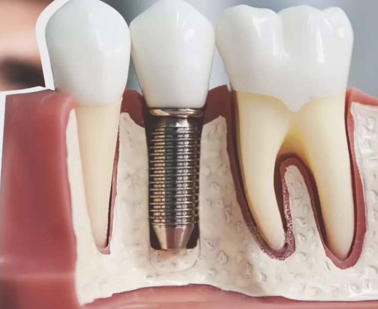 Современные Подходы к Протезированию Зубов: Основы и Технологии