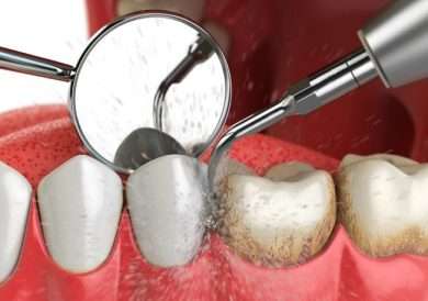 Зубной камень: коварный враг здоровья полости рта