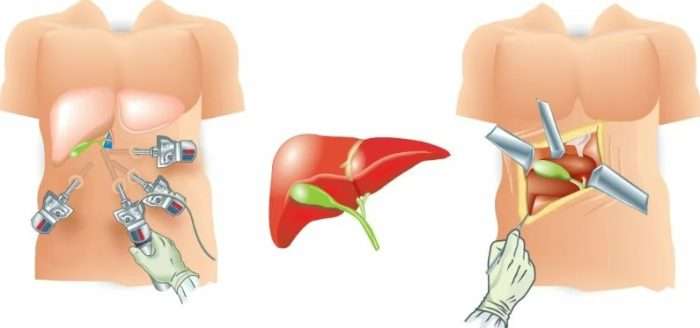 Хирургия желчного пузыря: Традиционные и малоинвазивные методы